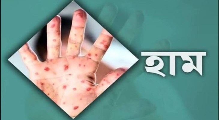 ২৪ ঘণ্টায় হামের উপসর্গে আরও ৩ শিশুর মৃত্যু 
